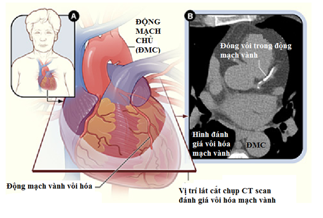 Quét canxi vành phát hiện sớm bệnh lý tim mạch Quét canxi vành phát hiện sớm bệnh lý tim mạch