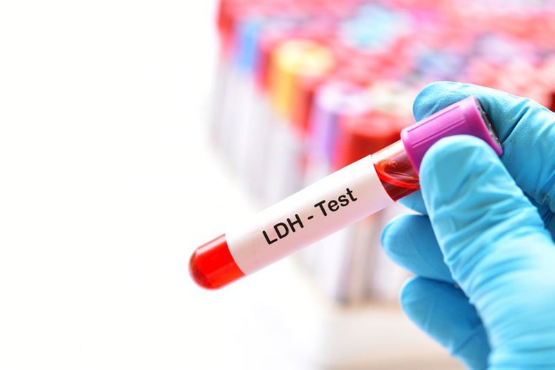 Xét nghiệm axit lactic dehydrogenase đo nồng độ của LHD trong máu Xét nghiệm axit lactic dehydrogenase đo nồng độ của LHD trong máu