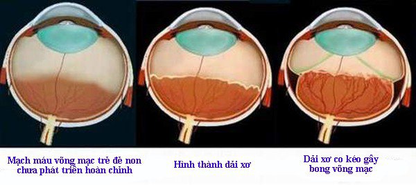 Tại sao trẻ sinh non, nhẹ cân cần tầm soát bệnh lý võng mạc sinh non? Tại sao trẻ sinh non, nhẹ cân cần tầm soát bệnh lý võng mạc sinh non?