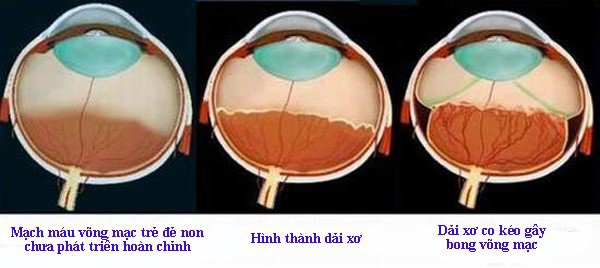 Các giai đoạn của bệnh lý võng mạc sinh non