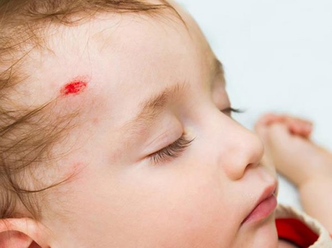 Hậu quả của tăng đường huyết sơ sinh Hậu quả của tăng đường huyết sơ sinh