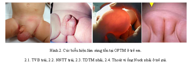 ống phúc tinh mạc bẩm sinh