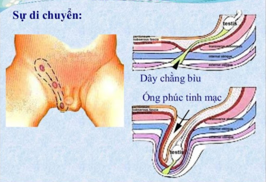 Tìm hiểu về bệnh lý ống phúc tinh mạc ở trẻ em Tìm hiểu về bệnh lý ống phúc tinh mạc ở trẻ em