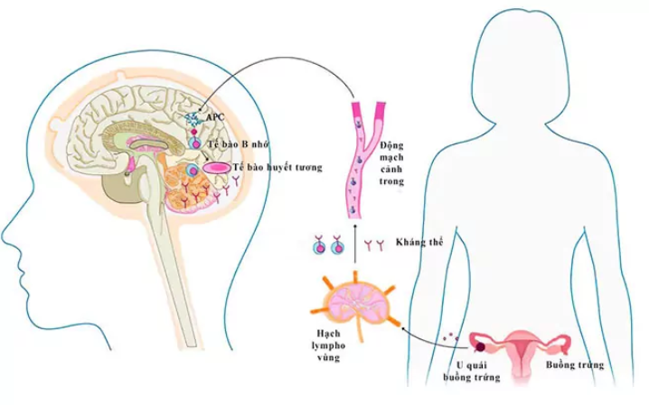 Tìm hiểu về căn bệnh viêm não tự miễn Tìm hiểu về căn bệnh viêm não tự miễn