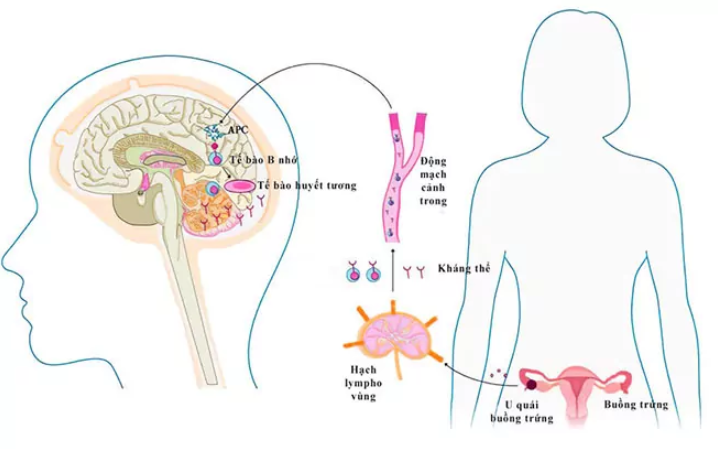 Bệnh viêm não tự miễn