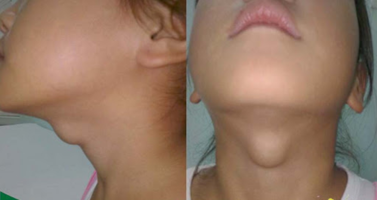 Nang (kén) giáp lưỡi ở trẻ em Nang (kén) giáp lưỡi ở trẻ em