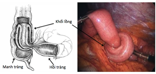 Tháo lồng ruột bằng phẫu thuật