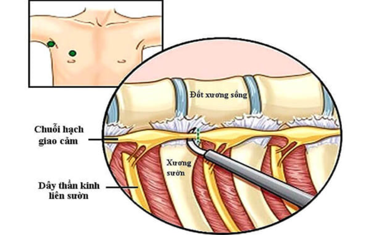 Mục đích của phẫu thuật nội soi cắt hạch giao cảm Mục đích của phẫu thuật nội soi cắt hạch giao cảm