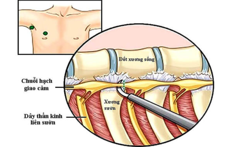 Cắt hạch giao cảm