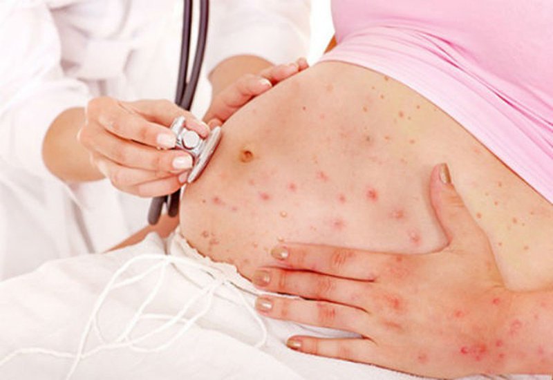 Những điều cần biết về xét nghiệm kháng thể thủy đậu Những điều cần biết về xét nghiệm kháng thể thủy đậu