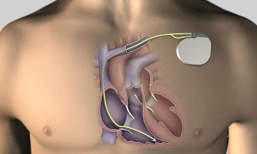 Tạo nhịp tim cấp cứu với điện cực trong buồng tim