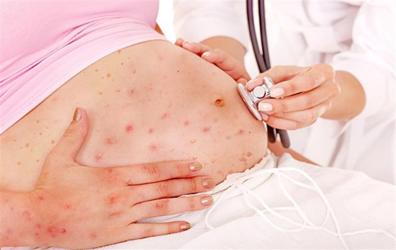 Thủy đậu ở trẻ sơ sinh Thủy đậu ở trẻ sơ sinh