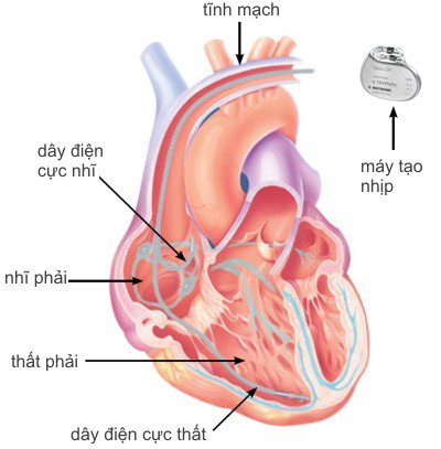 Tạo nhịp tim cấp cứu với điện cực trong buồng tim Tạo nhịp tim cấp cứu với điện cực trong buồng tim