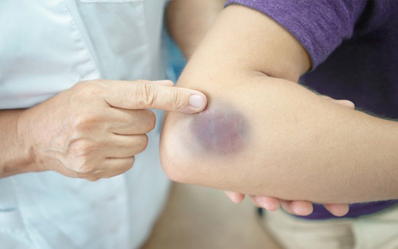 Tìm hiểu rối loạn giảm tiểu cầu ở trẻ em Tìm hiểu rối loạn giảm tiểu cầu ở trẻ em