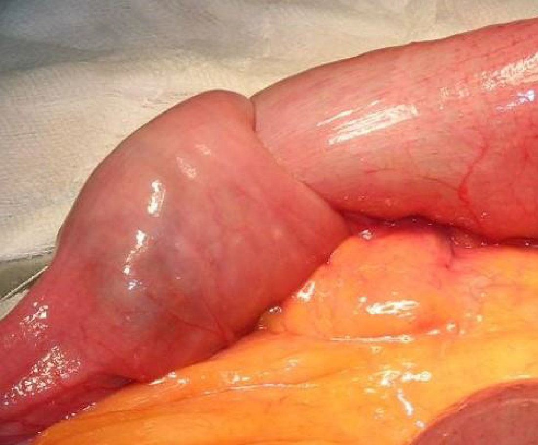 Điều trị lồng ruột cấp ở trẻ em Điều trị lồng ruột cấp ở trẻ em