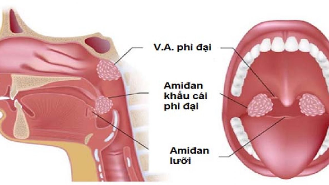 Phẫu thuật nội soi nạo VA bằng dao plasma ở trẻ em Phẫu thuật nội soi nạo VA bằng dao plasma ở trẻ em