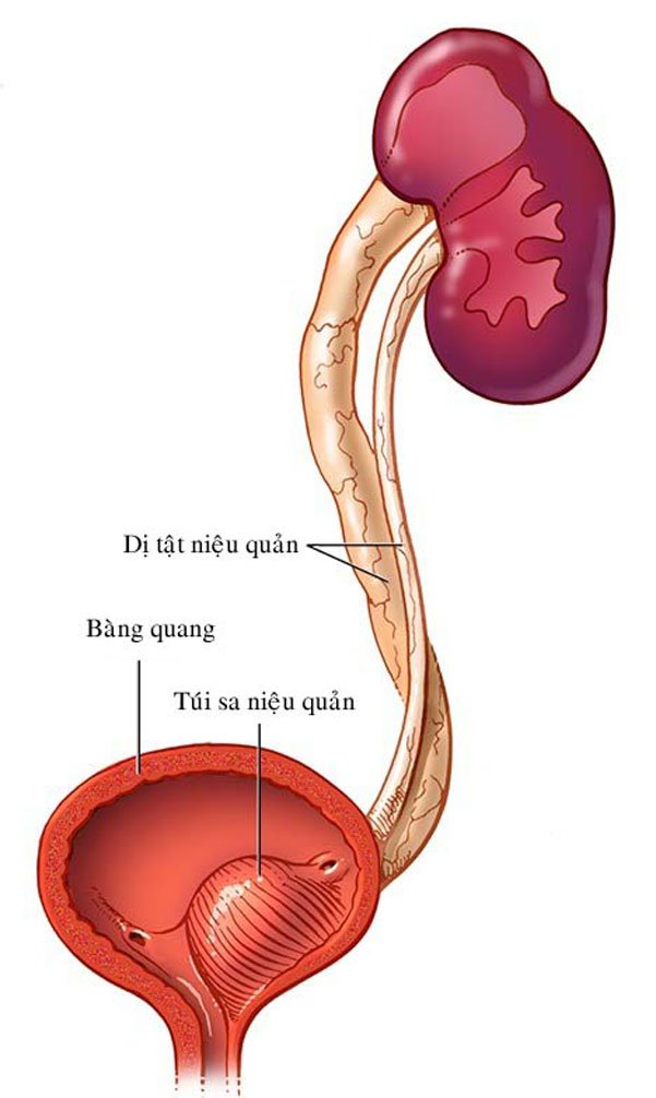 Tổng quan về bệnh nang niệu quản (túi sa niệu quản) bẩm sinh Tổng quan về bệnh nang niệu quản (túi sa niệu quản) bẩm sinh