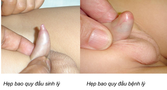 Cách phòng tránh nhiễm khuẩn tiết niệu ở trẻ em Cách phòng tránh nhiễm khuẩn tiết niệu ở trẻ em