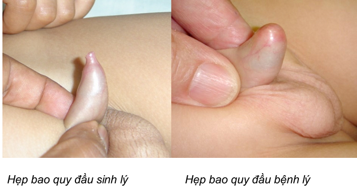 Hẹp bao quy đầu