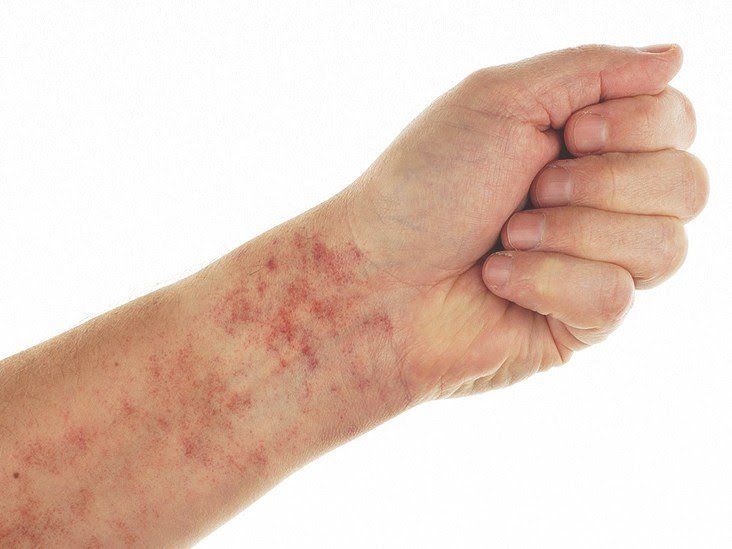 Biến chứng bệnh lý xuất huyết giảm tiểu cầu miễn dịch Biến chứng bệnh lý xuất huyết giảm tiểu cầu miễn dịch