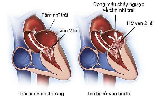 Tâm thất thường có 2 đường vào