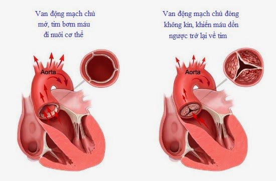 động mạch chủ bị vôi hóa nhiều