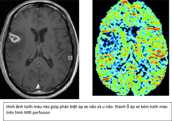 Chụp cộng hưởng từ tưới máu não (MRI perfusion) - P1 Chụp cộng hưởng từ tưới máu não (MRI perfusion) - P1