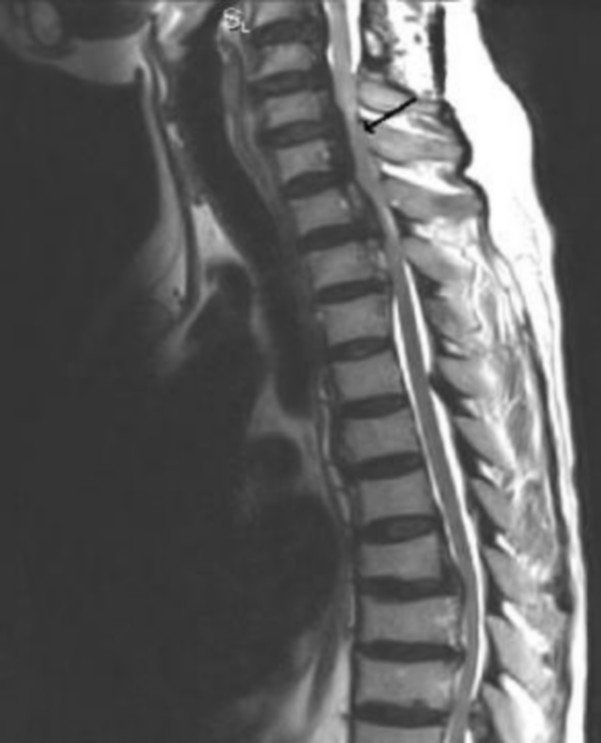 hình ảnh sagittal T2W