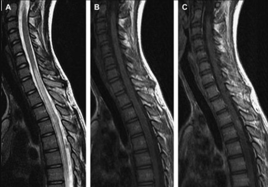 Cách đọc kết quả chụp cộng hưởng từ (MRI) cột sống cổ Cách đọc kết quả chụp cộng hưởng từ (MRI) cột sống cổ