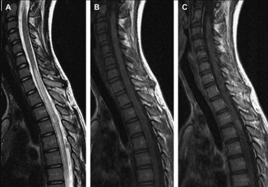 Hình sagittal T2W thấy bất thường tín hiệu kéo dài từ T7 đến L2.