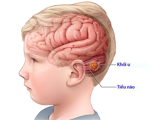 Trẻ em cần lưu ý gì khi chụp cộng hưởng từ sọ não Trẻ em cần lưu ý gì khi chụp cộng hưởng từ sọ não