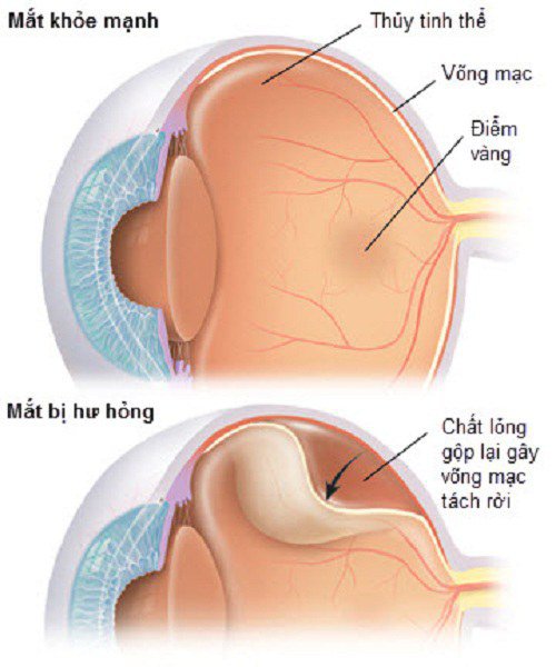 Nguyên nhân nào dẫn đến rách võng mạc?