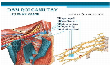 Các phương pháp gây tê đám rối thần kinh cánh tay Các phương pháp gây tê đám rối thần kinh cánh tay