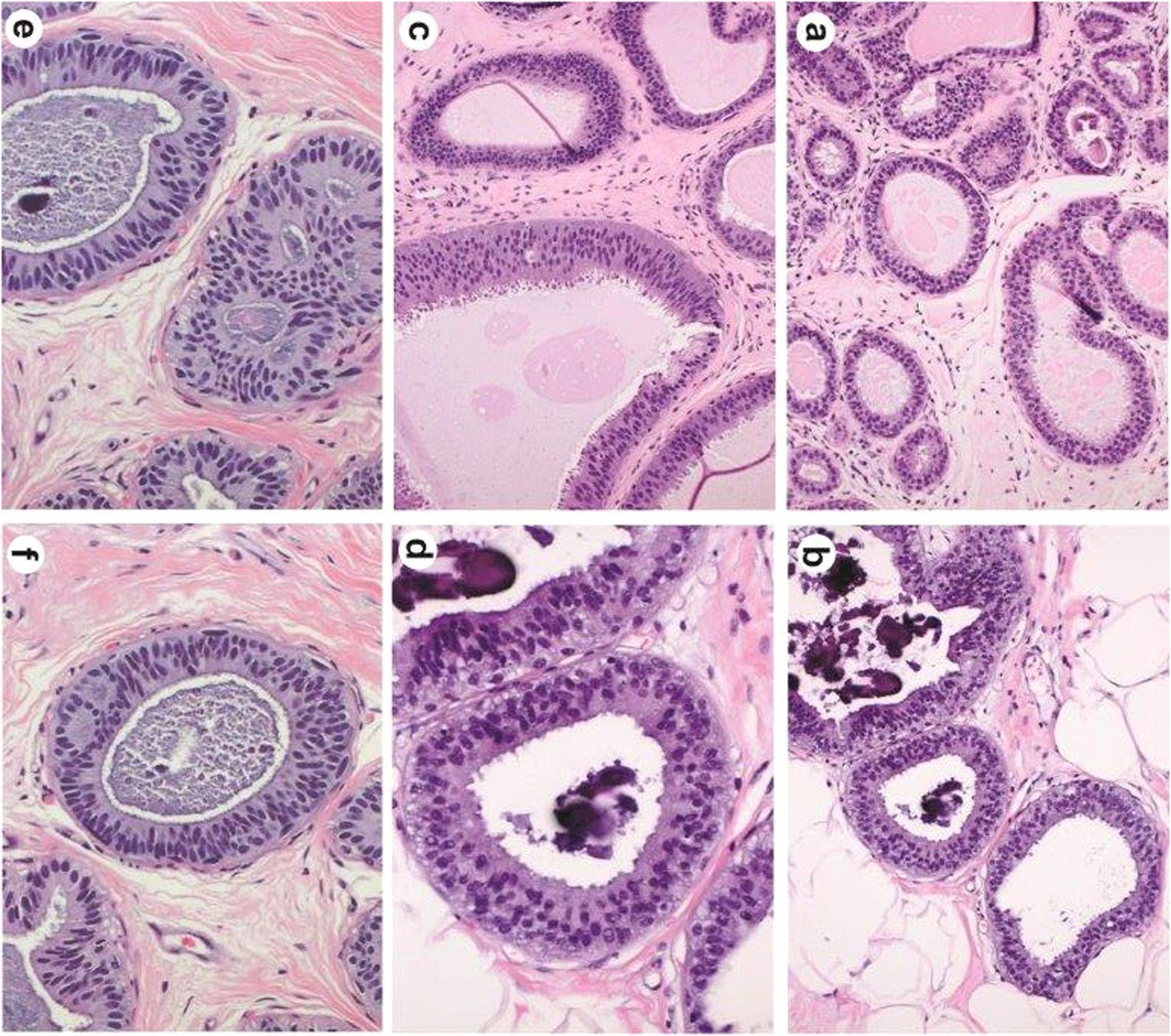 Flat epithelial atypical