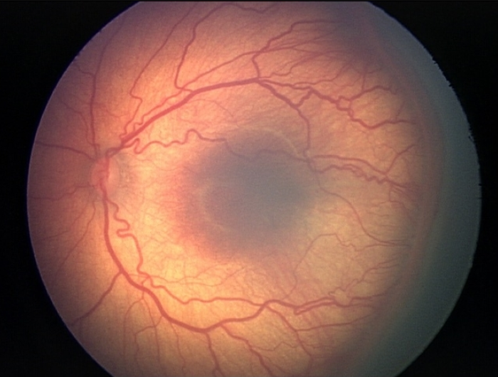 Retinopathy of prematurity- ROP