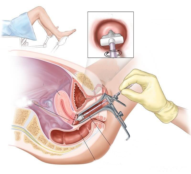 Xét nghiệm Pap sau mãn kinh Xét nghiệm Pap sau mãn kinh