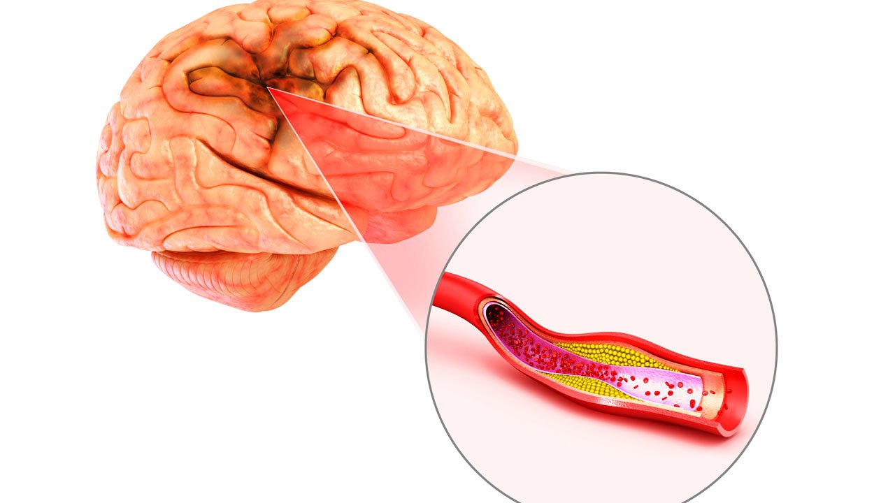 Can thiệp động mạch đốt sống: Những điều cần biết Can thiệp động mạch đốt sống: Những điều cần biết