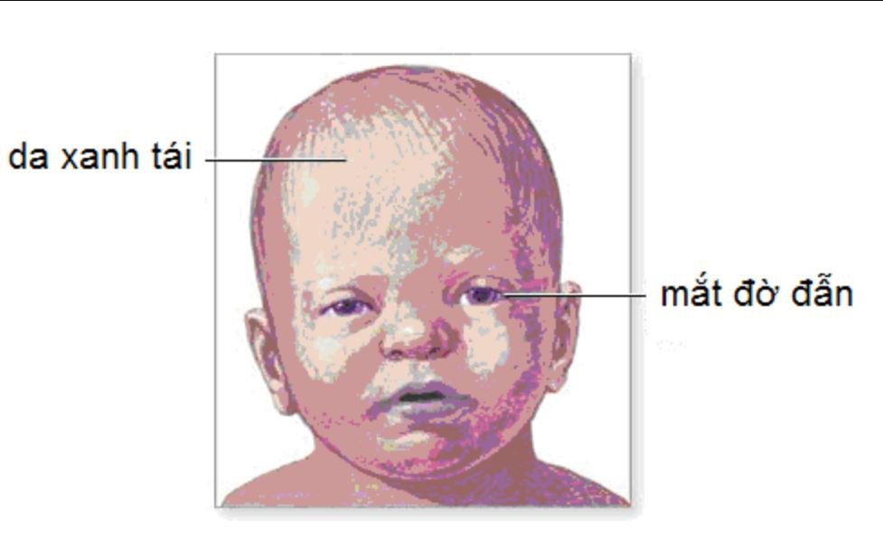 Trẻ bị rung lắc