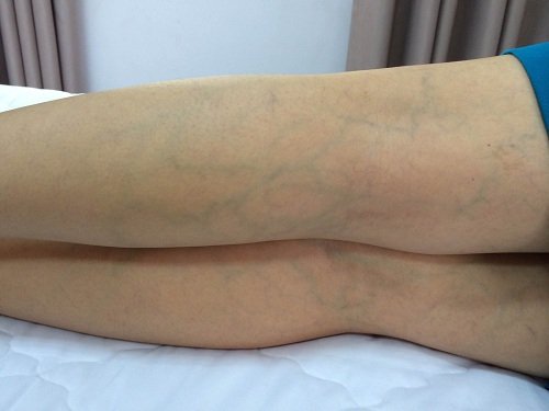 Tổn thương da trong bệnh xơ cứng bì hệ thống Tổn thương da trong bệnh xơ cứng bì hệ thống