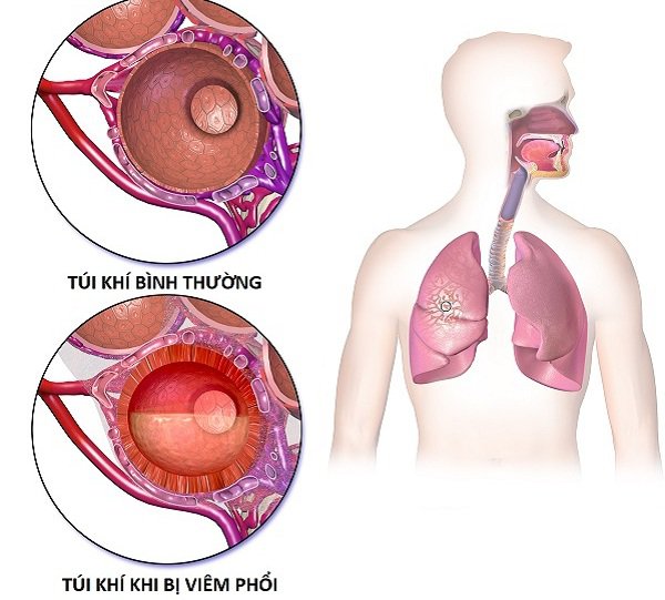 Viêm phổi cấp