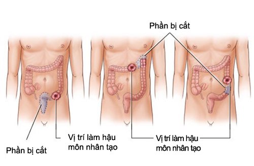 cắt đoạn trực tràng