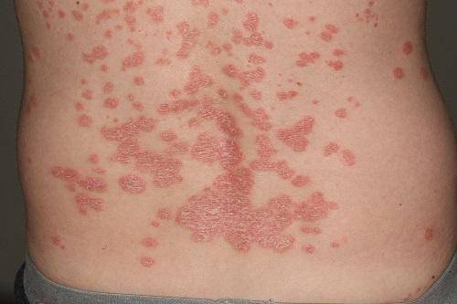 Bệnh vảy nến và mối liên với bệnh Crohn (viêm ruột từng vùng) Bệnh vảy nến và mối liên với bệnh Crohn (viêm ruột từng vùng)