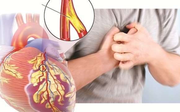 Sự nguy hiểm của mảng bám động mạch và động mạch bị tắc Sự nguy hiểm của mảng bám động mạch và động mạch bị tắc