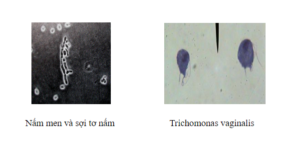Xét nghiệm soi tươi - nhuộm huyết trắng giúp phát hiện các tác nhân gây viêm âm đạo Xét nghiệm soi tươi - nhuộm huyết trắng giúp phát hiện các tác nhân gây viêm âm đạo