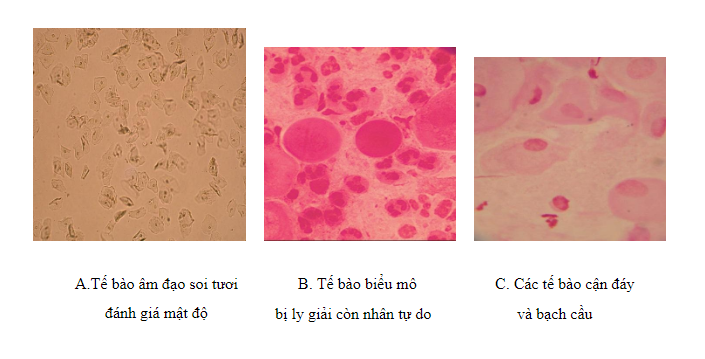 Xét nghiệm soi tươi - nhuộm huyết trắng giúp phát hiện các tác nhân gây viêm âm đạo Xét nghiệm soi tươi - nhuộm huyết trắng giúp phát hiện các tác nhân gây viêm âm đạo