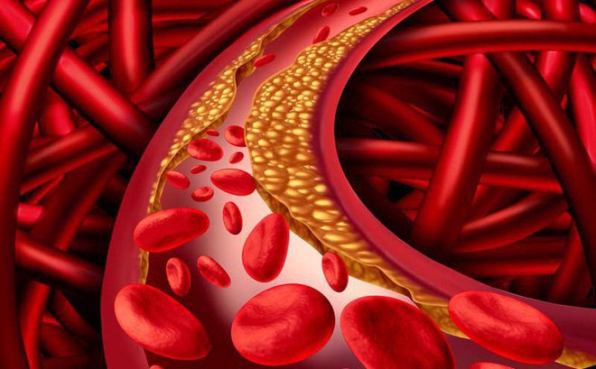 Điều trị tăng cholesterol máu ở người cao tuổi Điều trị tăng cholesterol máu ở người cao tuổi