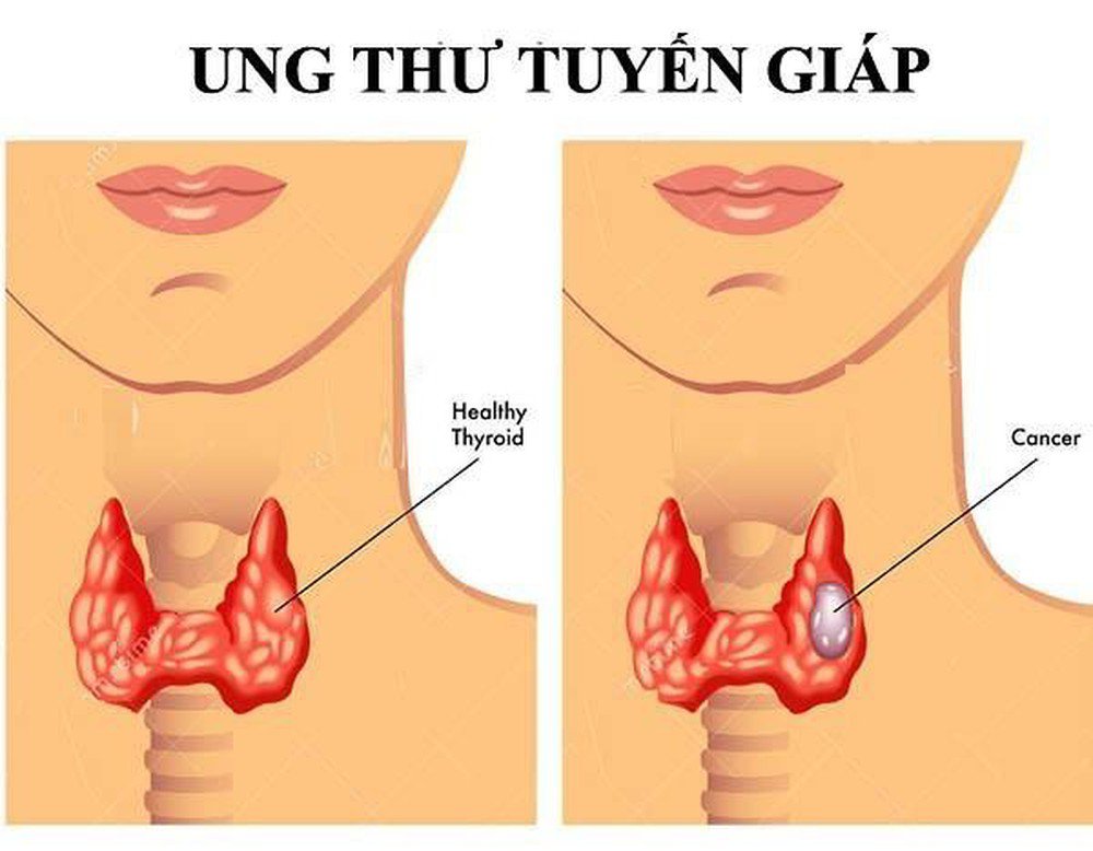 Ung thư tuyến giáp có rất nhiều thể