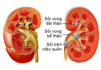 Mổ nội soi điều trị sỏi niệu đạo Mổ nội soi điều trị sỏi niệu đạo