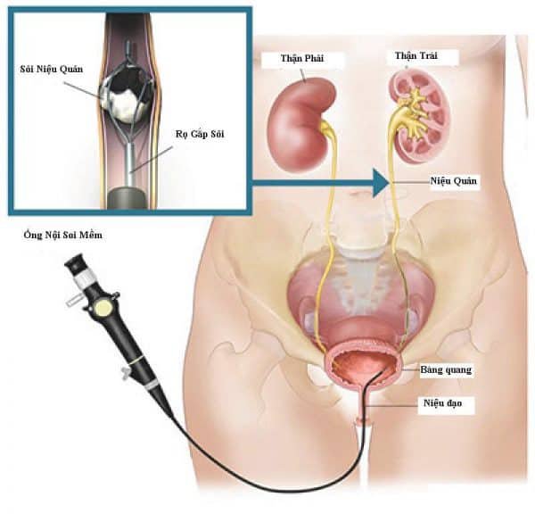 Mổ nội soi tán sỏi niệu đạo bằng laser là phương pháp điều trị hiện đại nhất hiện nay