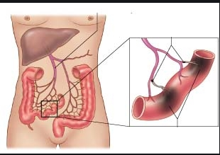 Nhồi máu động mạch mạc treo do huyết khối